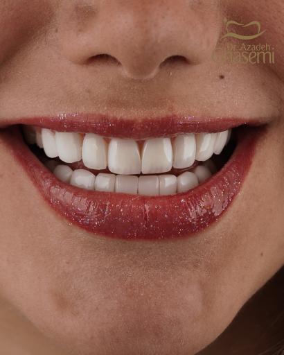عکس دندانپزشکی  زیبایی دکتر آزاده قاسمی کامپوزیت و لمینیت