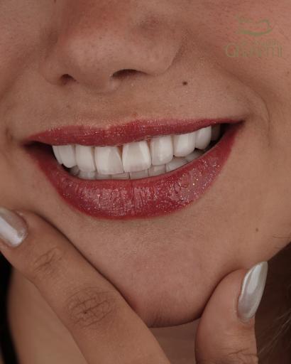 عکس دندانپزشکی  زیبایی دکتر آزاده قاسمی کامپوزیت و لمینیت