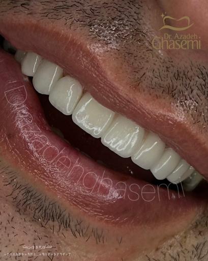 عکس دندانپزشکی  زیبایی دکتر آزاده قاسمی کامپوزیت و لمینیت