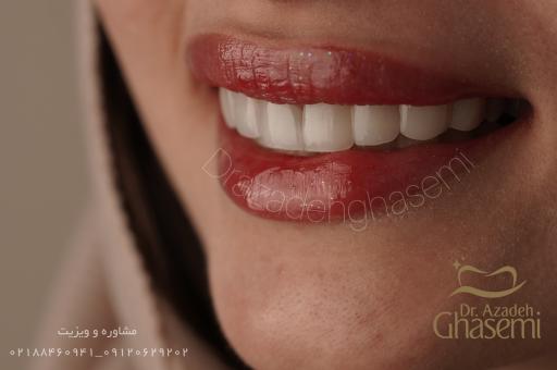 عکس دندانپزشکی  زیبایی دکتر آزاده قاسمی کامپوزیت و لمینیت