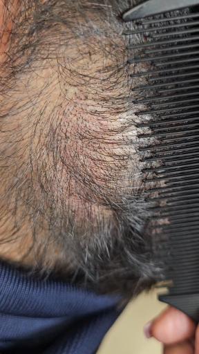 عکس میکرواسکالپ قزوین