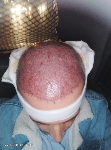 عکس کلینیک کاشت مو ارغوان