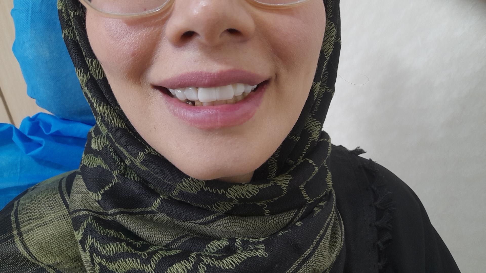 عکس دندانسازی عرفان